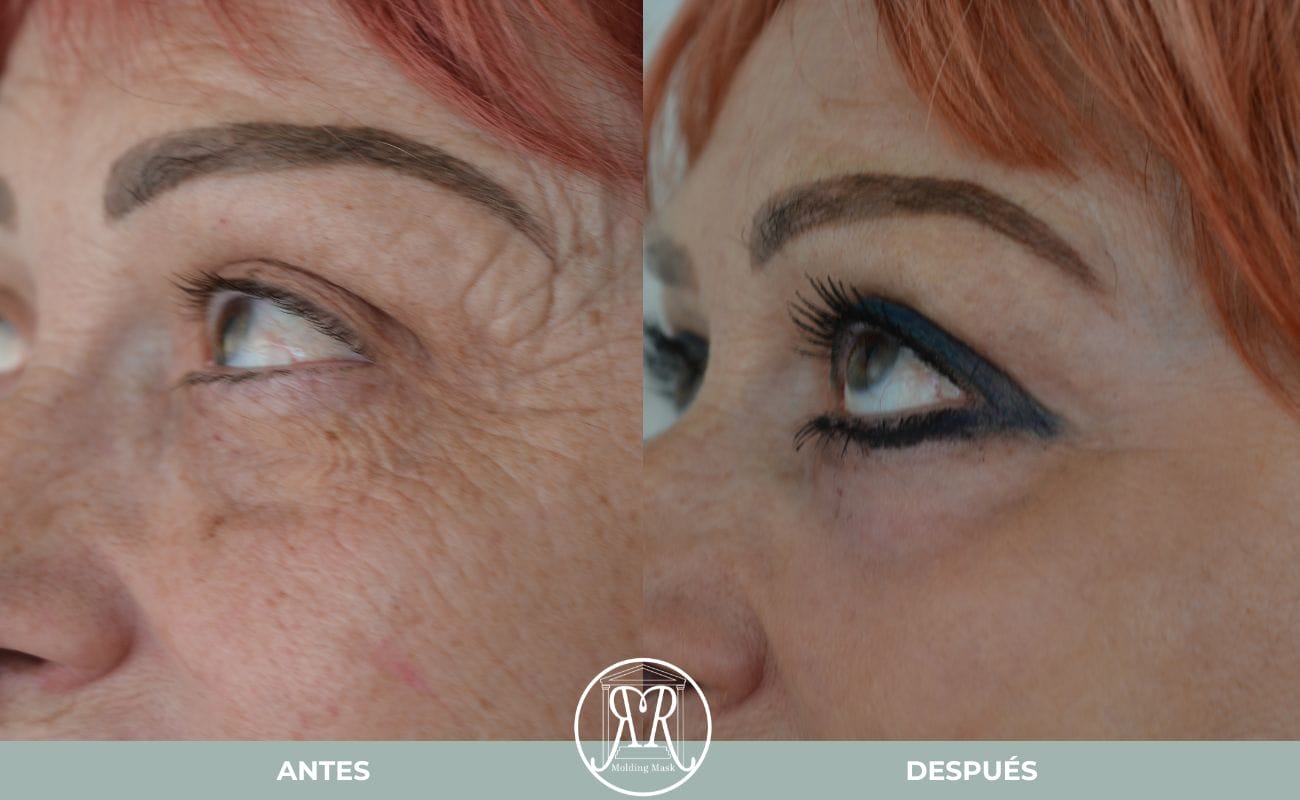 Antes y después del Molding Mask y Molding Contour en Gijón