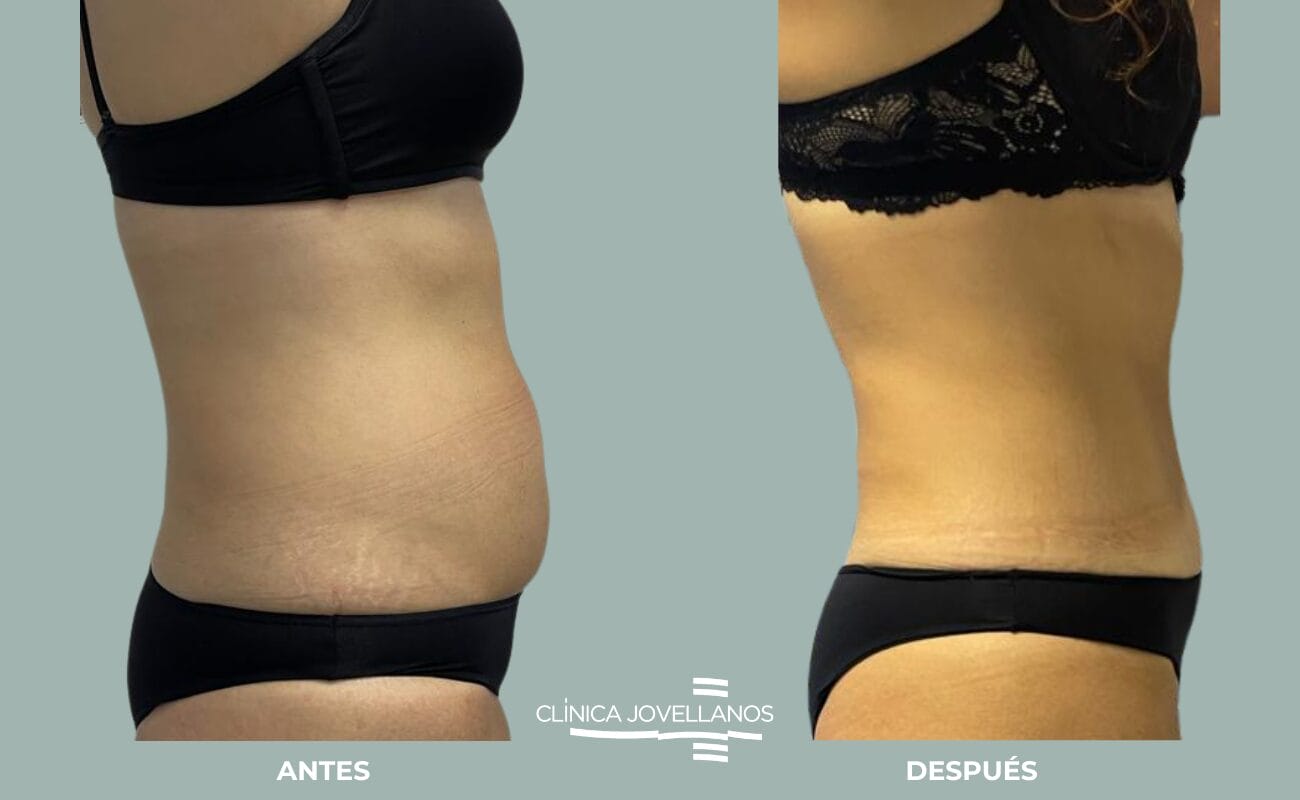 Antes y después Lipoabdominoplastia