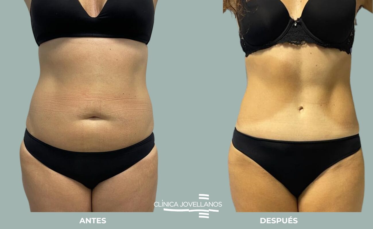 Resultado de una Lipoabdominoplastia