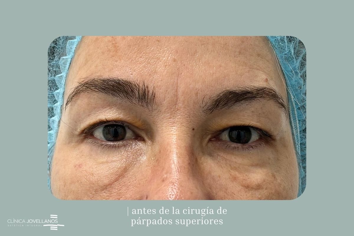 Antes de una blefaroplastia superior.