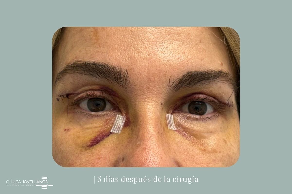 Evolución de una blefaroplastia superior cinco días después de la cirugía.
