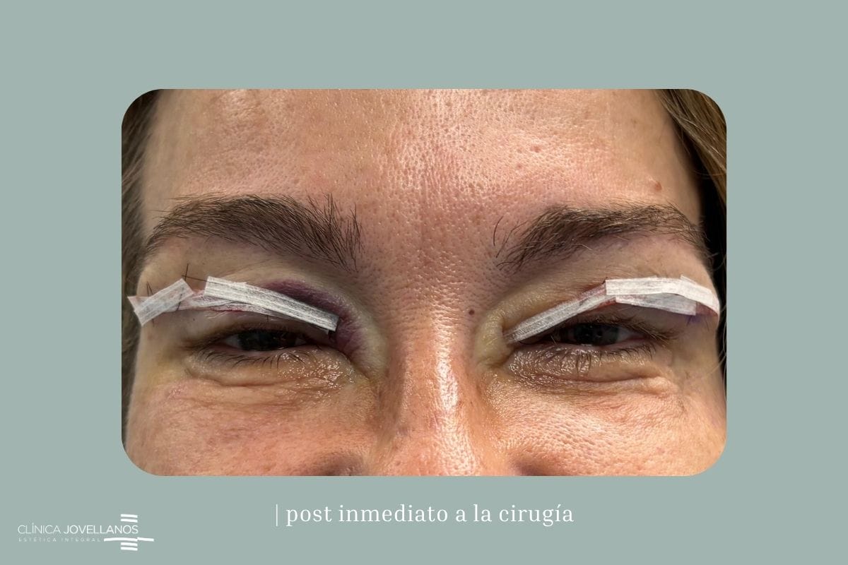 Postoperatorio inmediato tras una blefaroplastia superior.