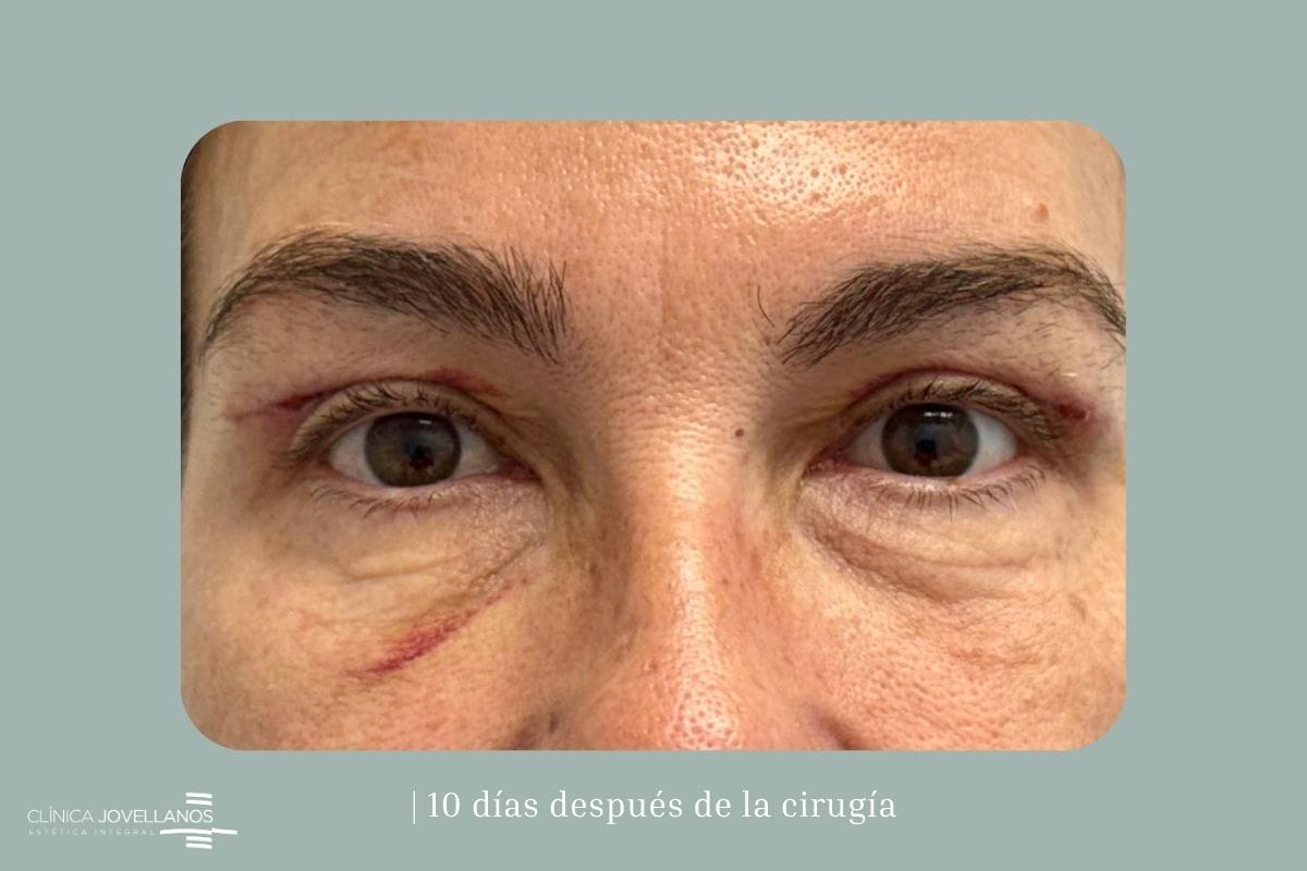 Resultado de una blefaroplastia superior diez días después de la intervención.