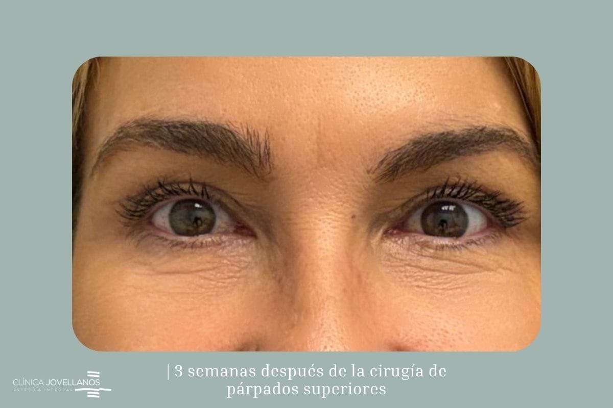 Resultado de una blefaroplastia superior tres semanas después de la cirugía.