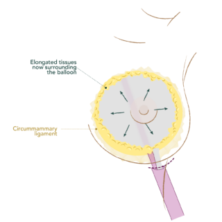 Ilustración del paso 2 de Preservé: preparación del espacio con balón expansor