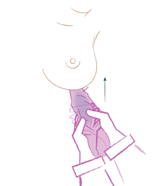 Ilustración del paso 3 de Preservé: colocación del implante con técnica no touch
